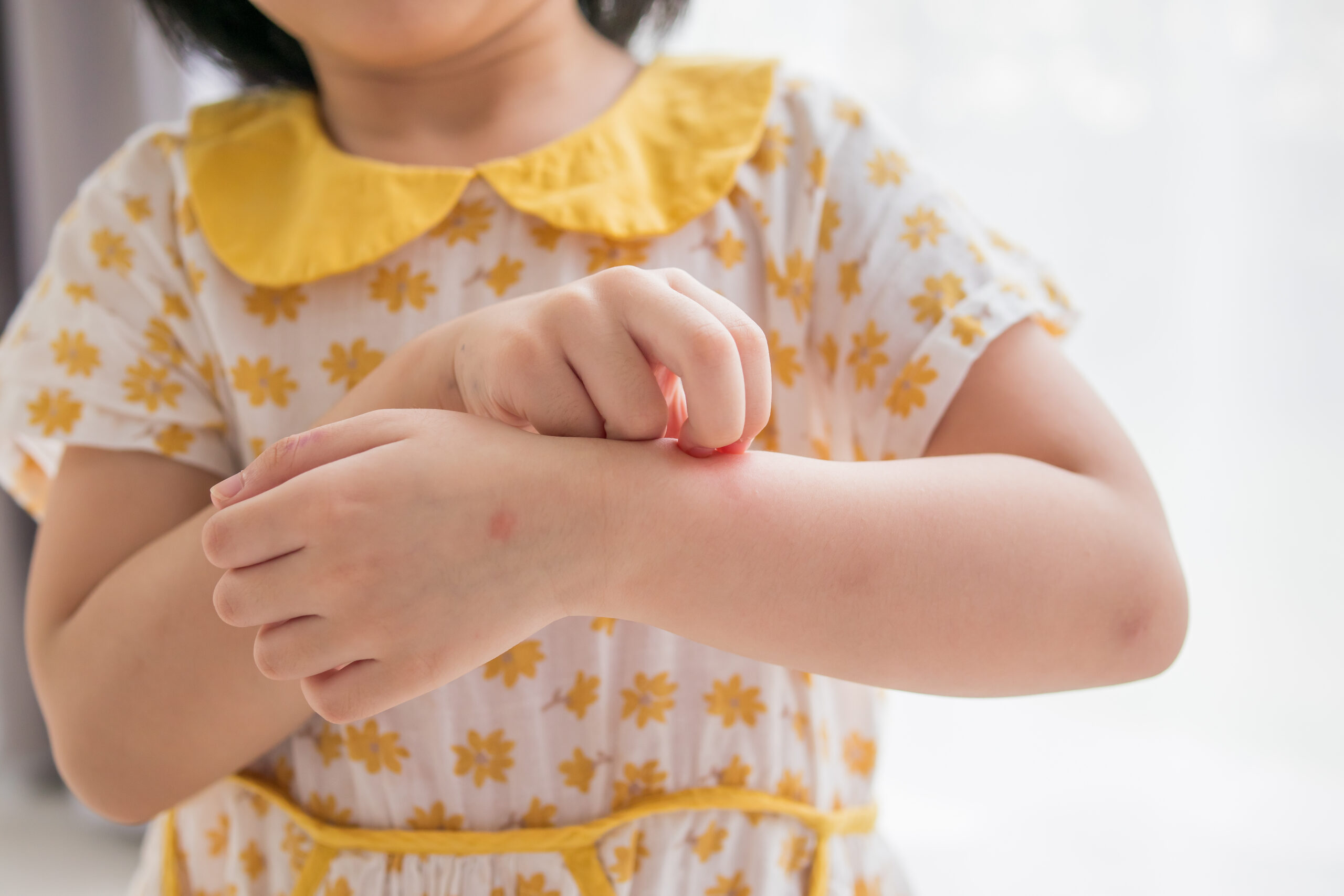 varicela en niños
